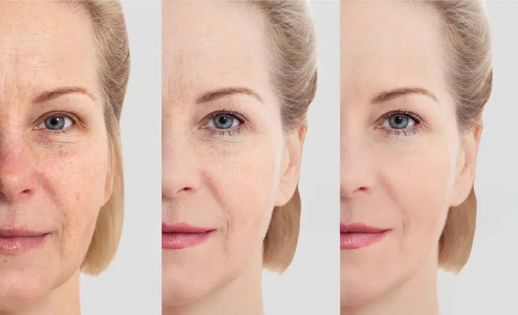 Results showing a gentle skin rejuvenation before and after treatment.