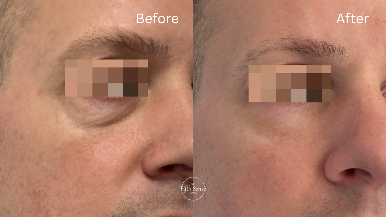 polynucleotides treatment by Dr Asra from the Fifth Sense clinic Cheadle Hulme