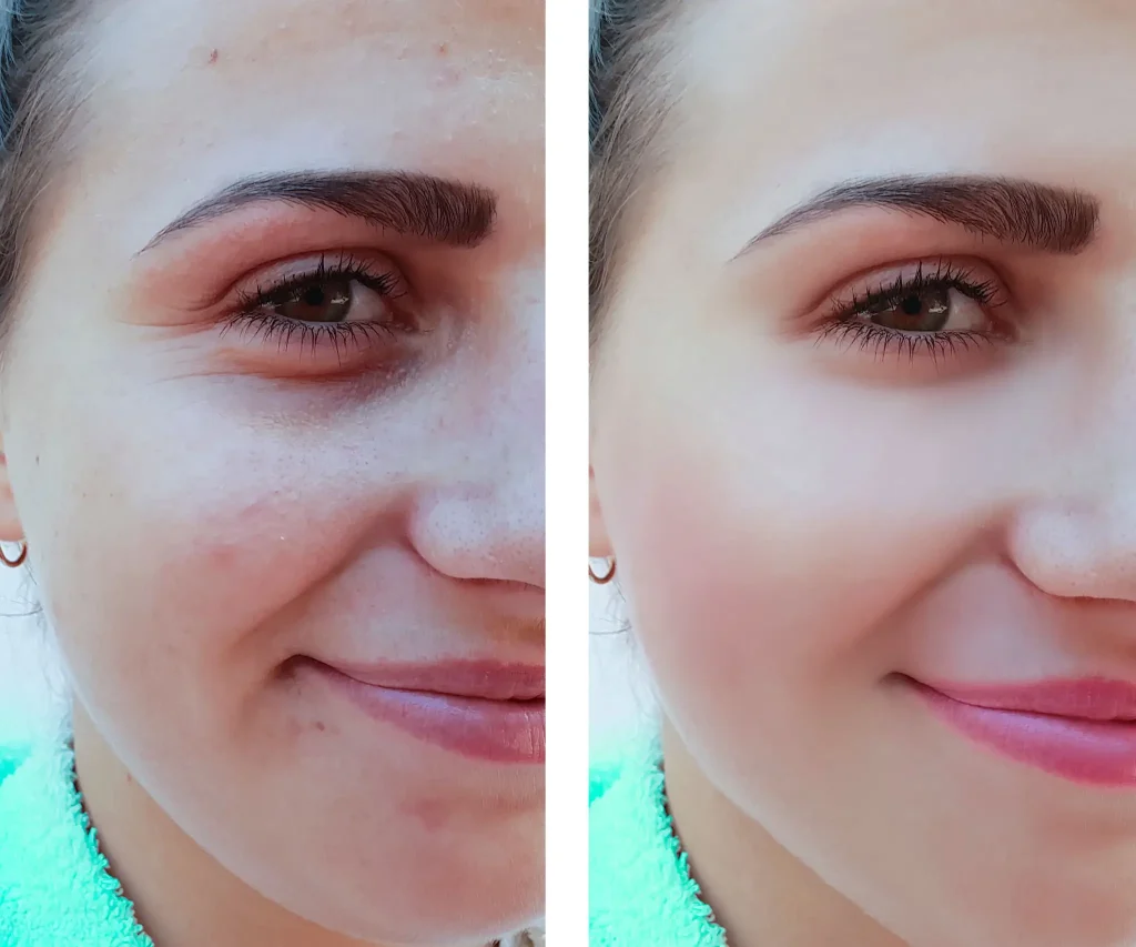 chemical peel skin rejuvenation treatment