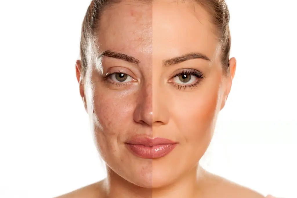 professional chemical peel for acne scars Manchester