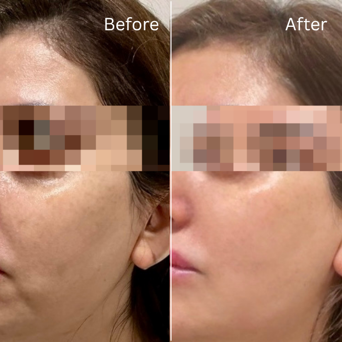 Mesotox before and after, tighter more even skin