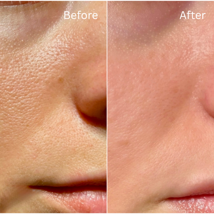 Mesotox before and after, close up of pores
