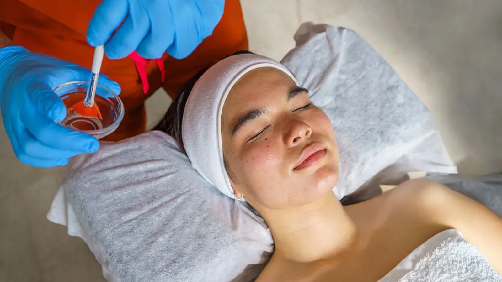 chemical-peel-treatment-4
