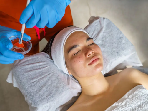 chemical-peel-treatment-4