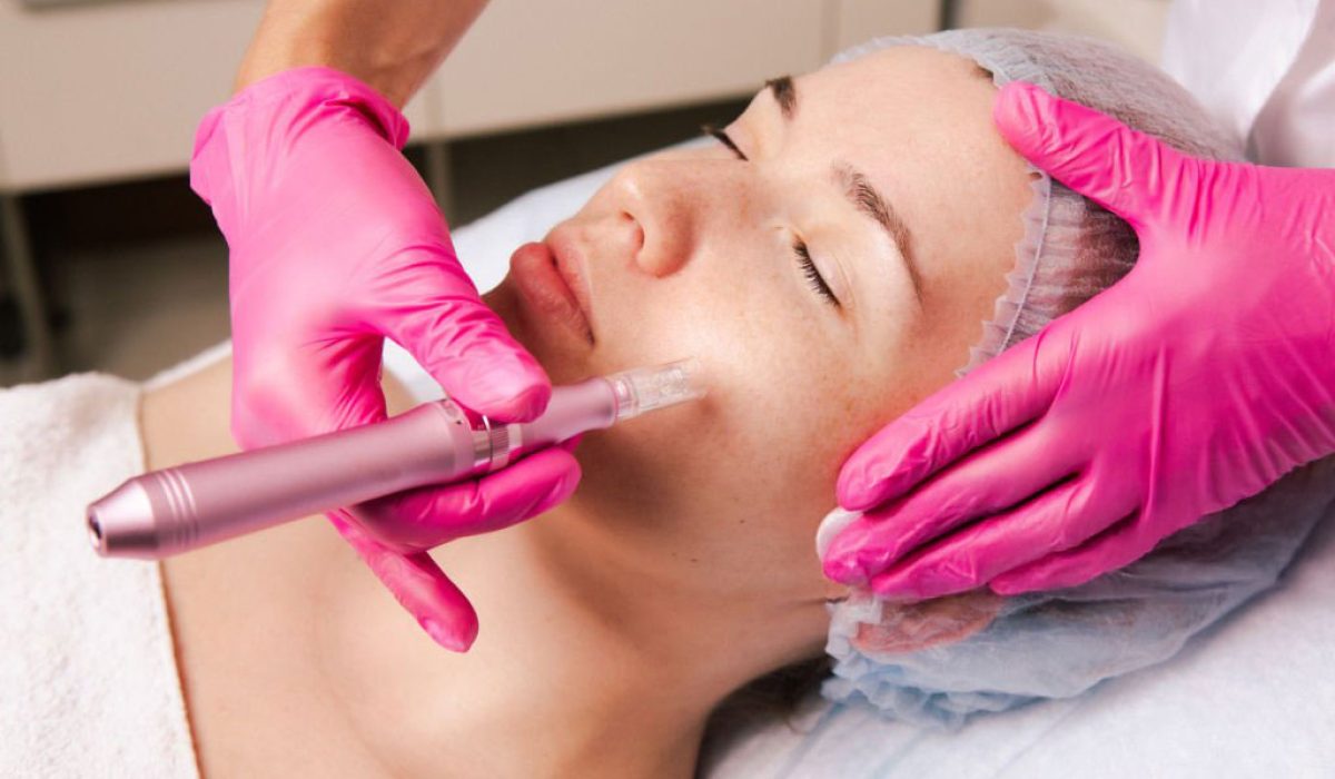 microneedling-1