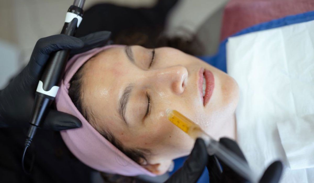 microneedling-2